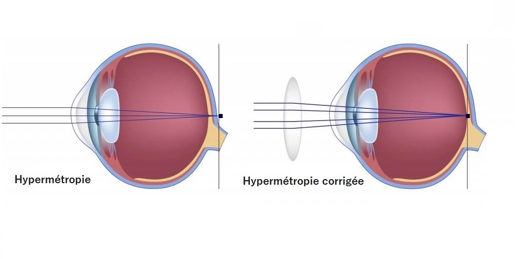 hypermétropie