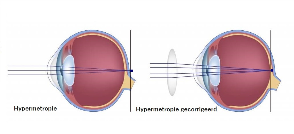 visus met hypermetropie