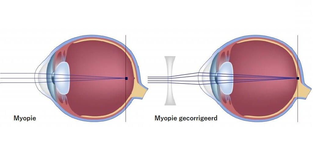 visus met myopia