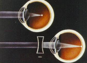 image perçue par un oeil myope